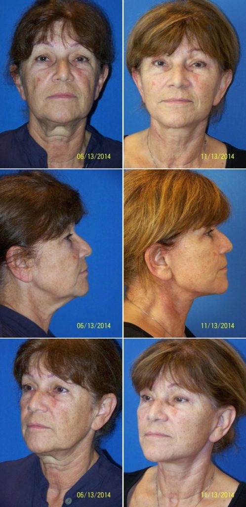Before and After Image: Facelift Surgery - other