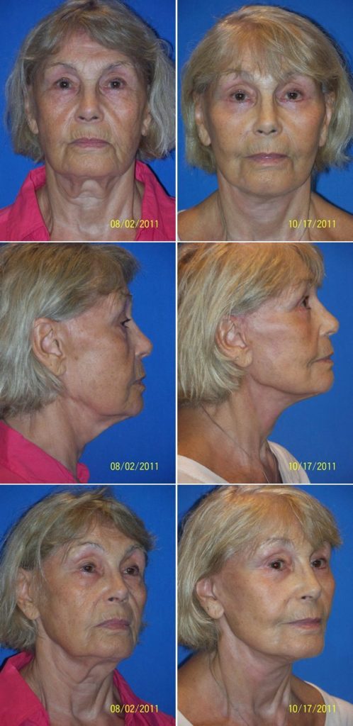 Before and After Image: Facelift Surgery - other