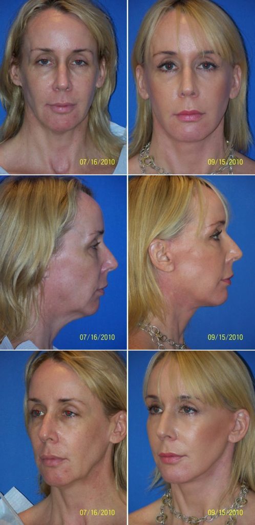 Before and After Image: Facelift Surgery - other