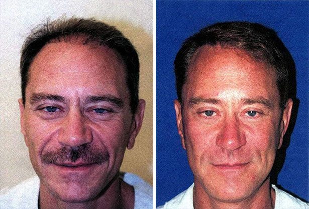 Before and After Image: Facelift Surgery - front