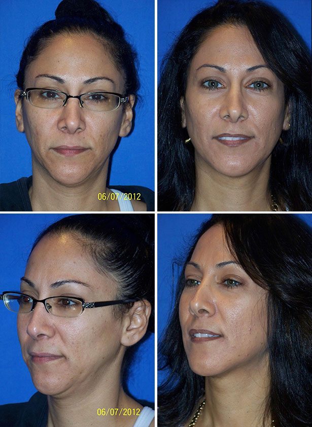 Before and After Image: Fat Transfer - other