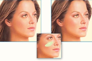 fimp cheek 302x200 2 Facial Implants in Miami, FL