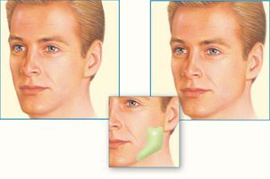 fimp jaw 3 Facial Implants in Miami, FL