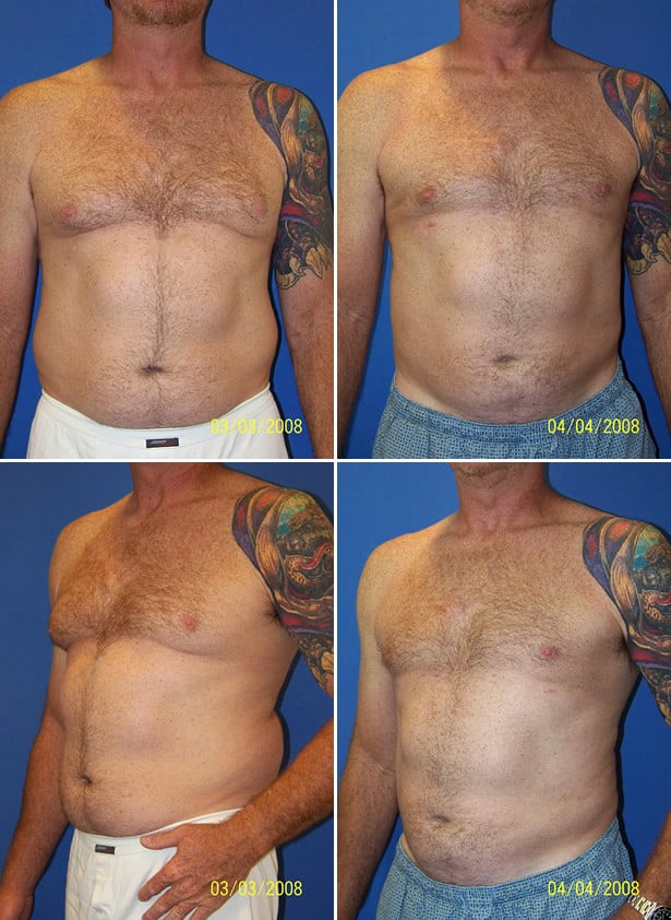 Before and After Image: Male Pectoral Implant - other