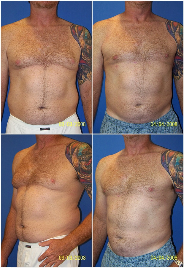Before and After Image: Gynecomastia Correction - other