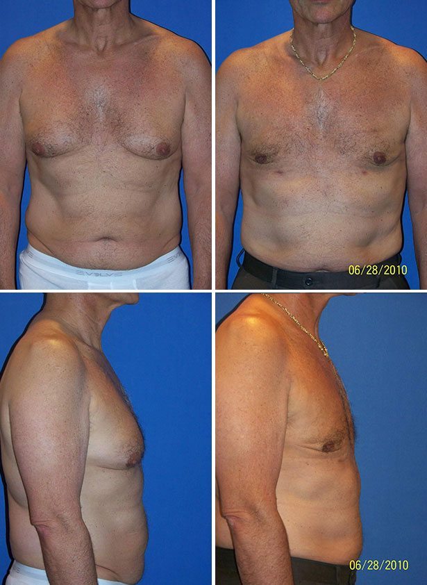 Before and After Image: Gynecomastia (Male Breast Reduction) - other