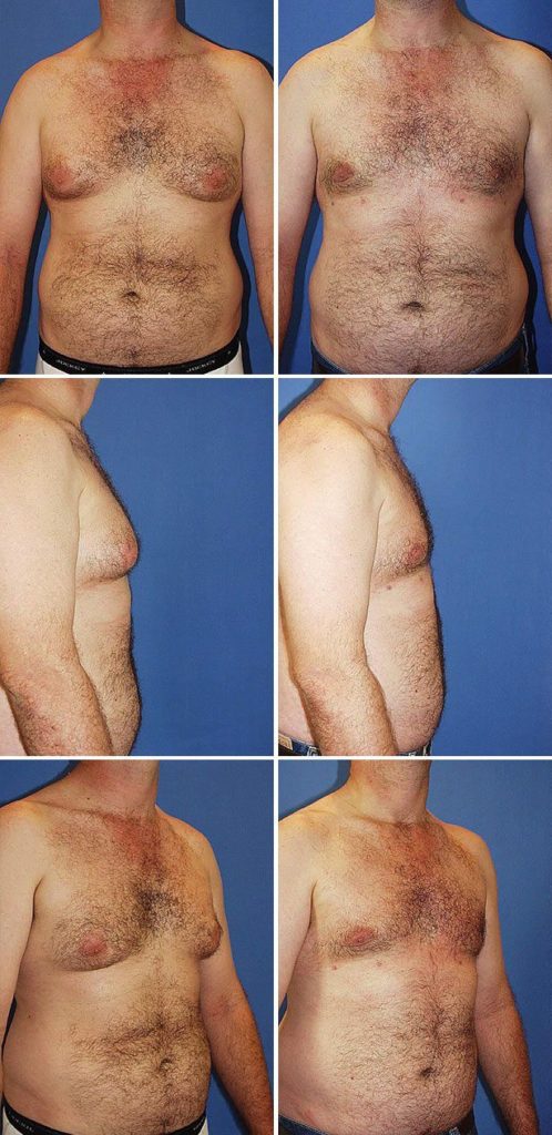 Before and After Image: Gynecomastia (Male Breast Reduction) - other
