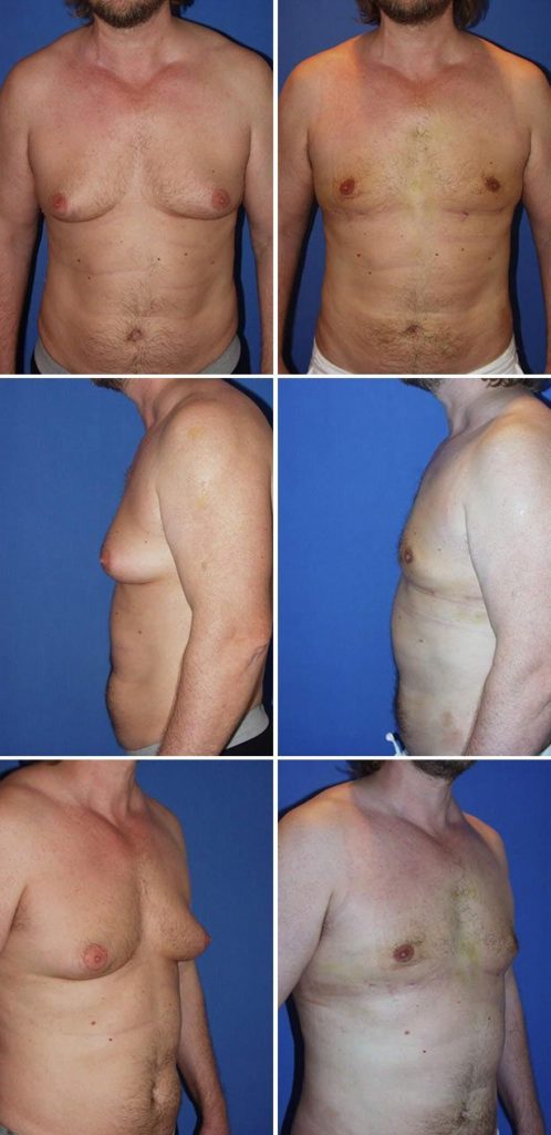 Before and After Image: Gynecomastia (Male Breast Reduction) - other
