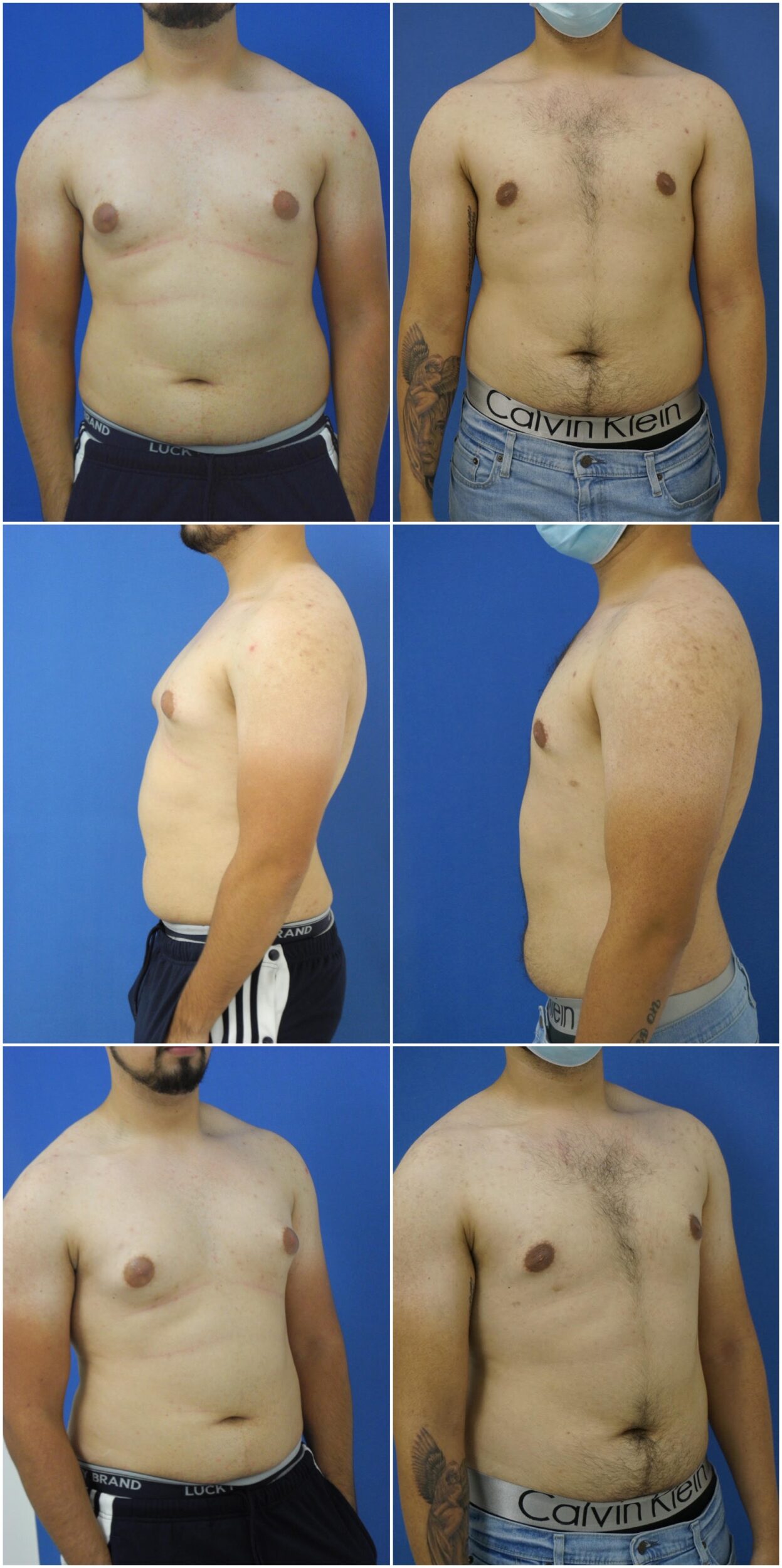 Before and After Image: Gynecomastia Correction - other