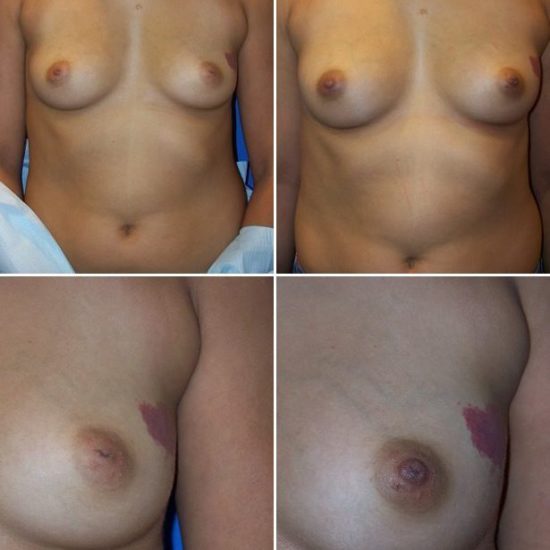 Before and After Image: Inverted Nipple Repair - other