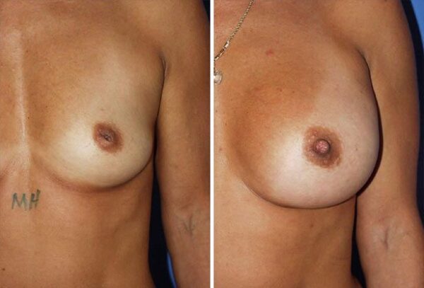 Before and After Image: Inverted Nipple Repair - front