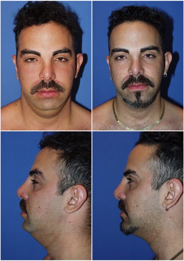 Before and After Image: Neck Liposuction Surgery - other