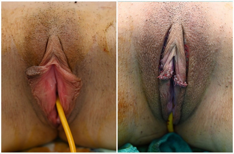 Before and After Image: Labiaplasty - front