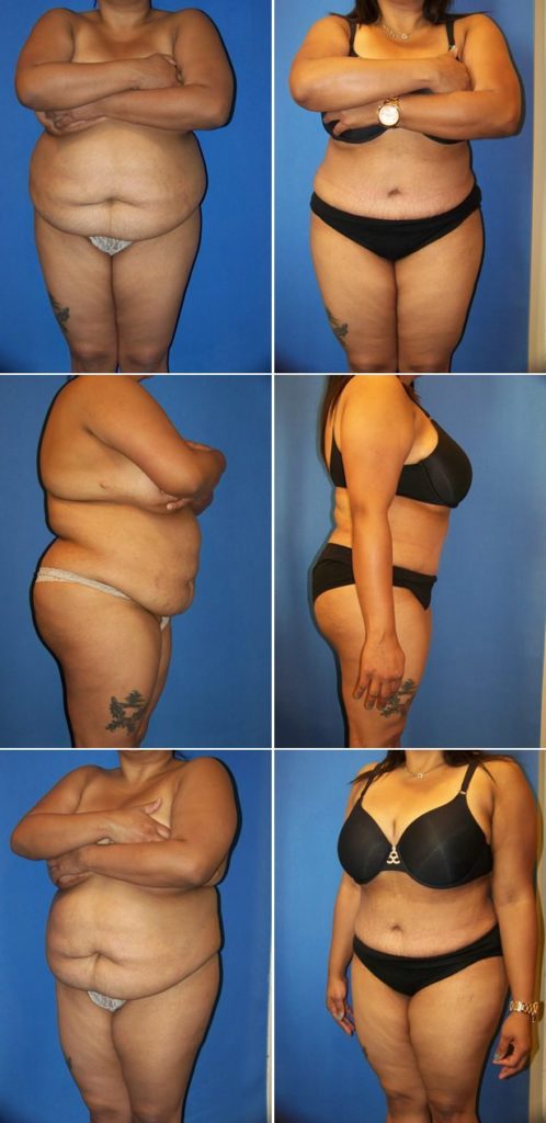 Before and After Image: Liposuction / Liposculpture Surgery - other