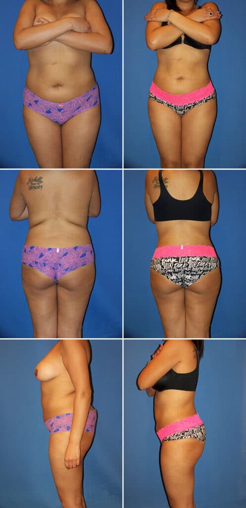 Before and After Image: Liposuction / Liposculpture Surgery - other
