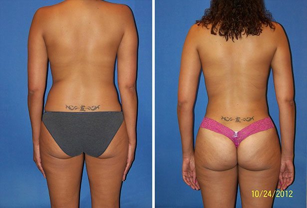 Before and After Image: Liposuction / Liposculpture Surgery - back