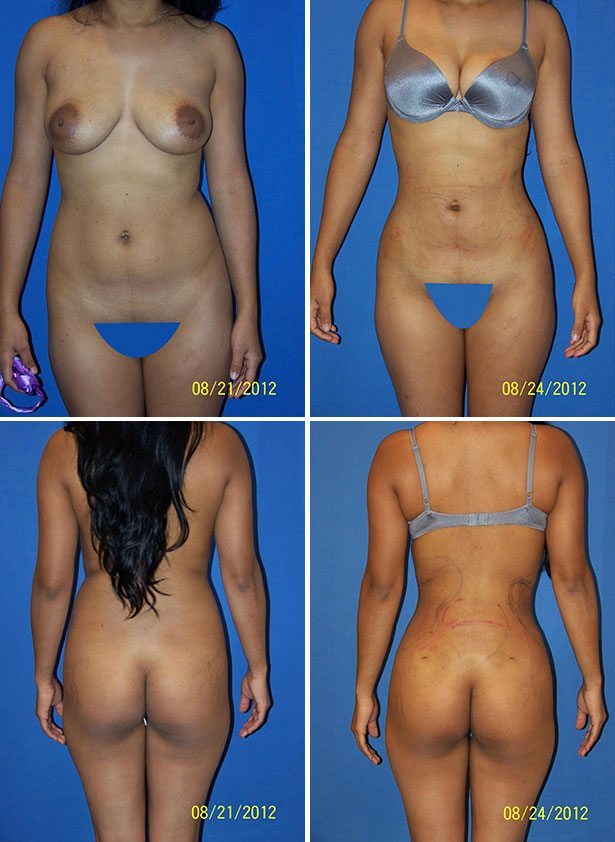 Before and After Image: Liposuction / Liposculpture Surgery - other