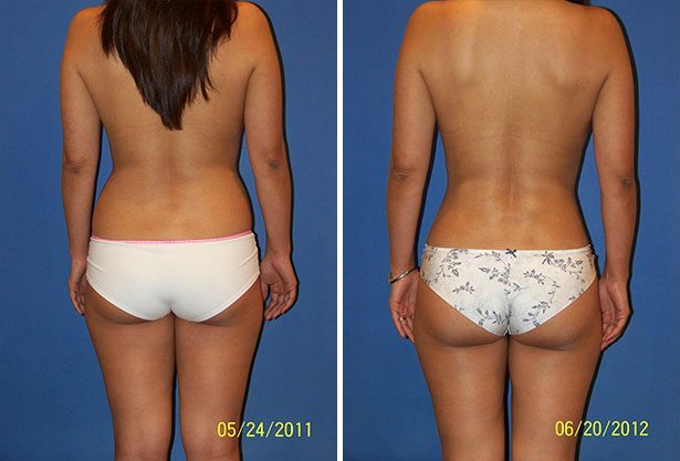 Before and After Image: Liposuction / Liposculpture Surgery - back