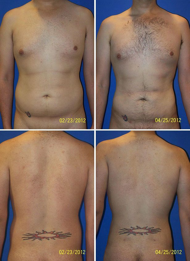 Before and After Image: Liposuction / Liposculpture Surgery - other