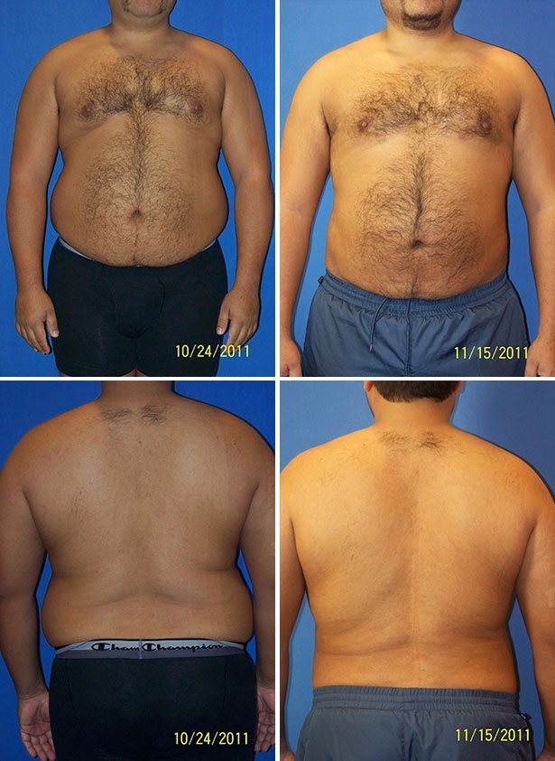 Before and After Image: Liposuction / Liposculpture Surgery - other