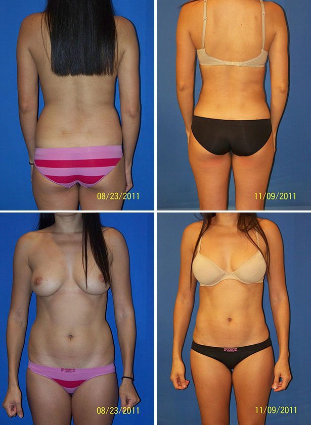 Before and After Image: Liposuction / Liposculpture Surgery - other
