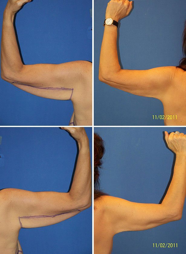 Before and After Image: Liposuction / Liposculpture Surgery - other
