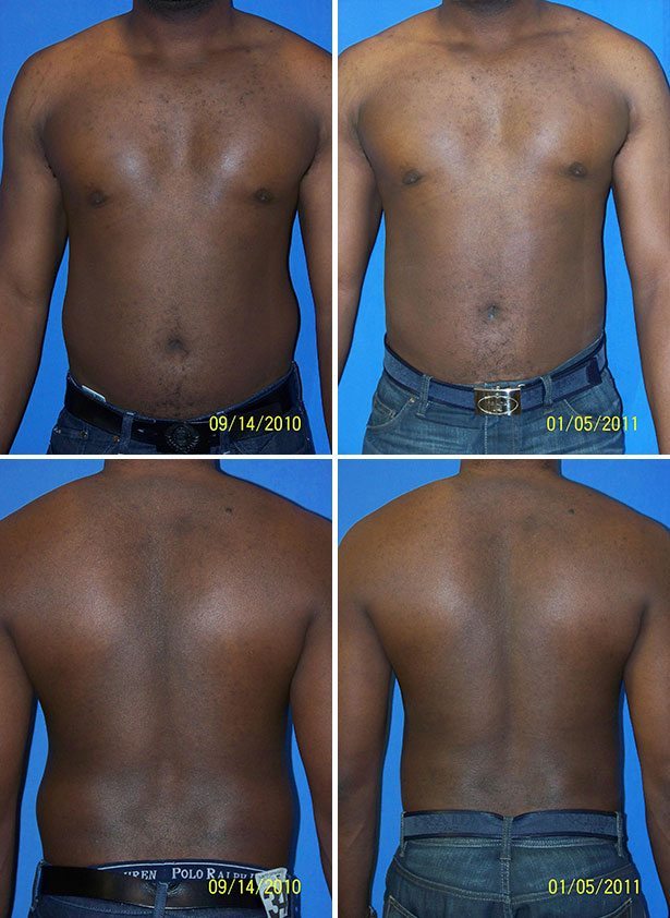 Before and After Image: Liposuction / Liposculpture Surgery - other