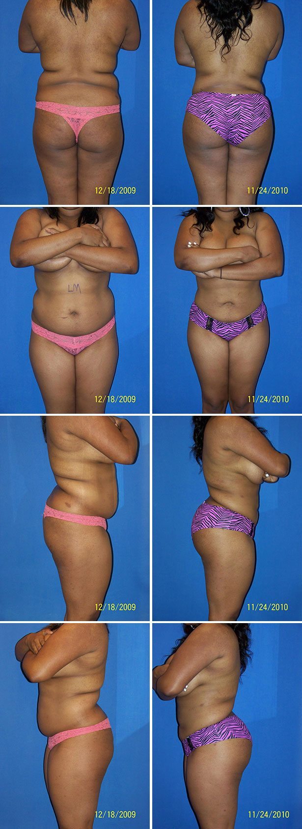 Before and After Image: Liposuction / Liposculpture Surgery - other