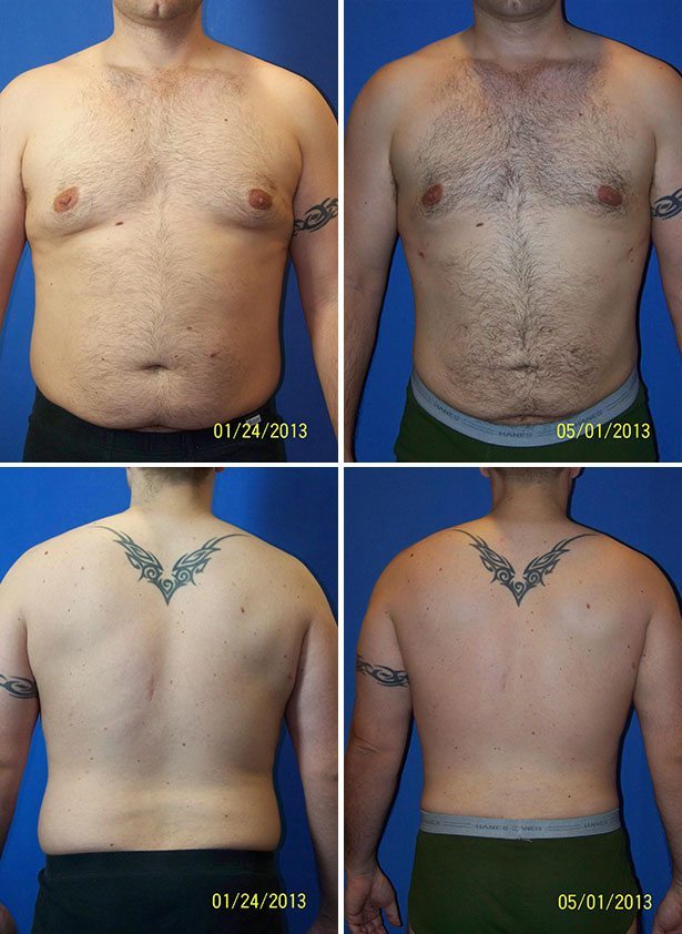 Before and After Image: Liposuction / Liposculpture Surgery - other