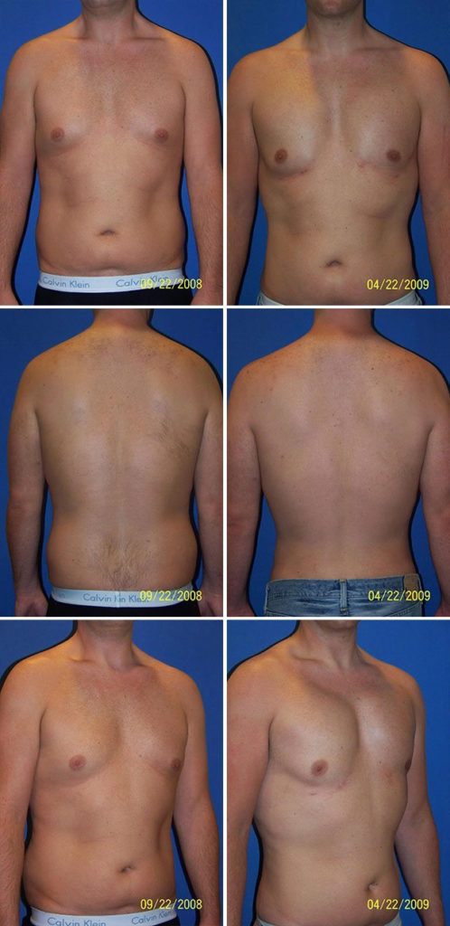 Before and After Image: Liposuction / Liposculpture Surgery - other