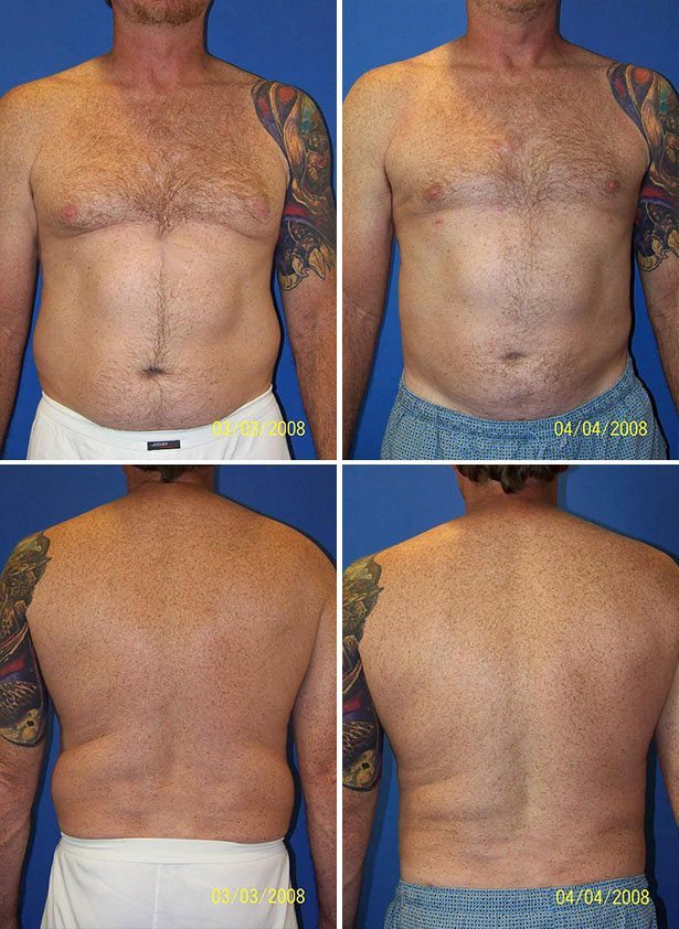 Before and After Image: Liposuction / Liposculpture Surgery - other