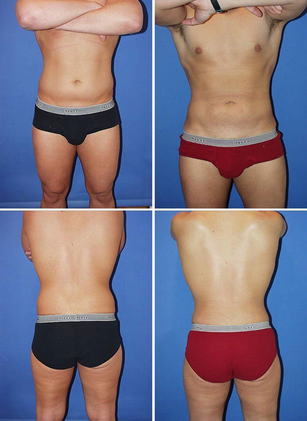 Before and After Image: Liposuction / Liposculpture Surgery - other