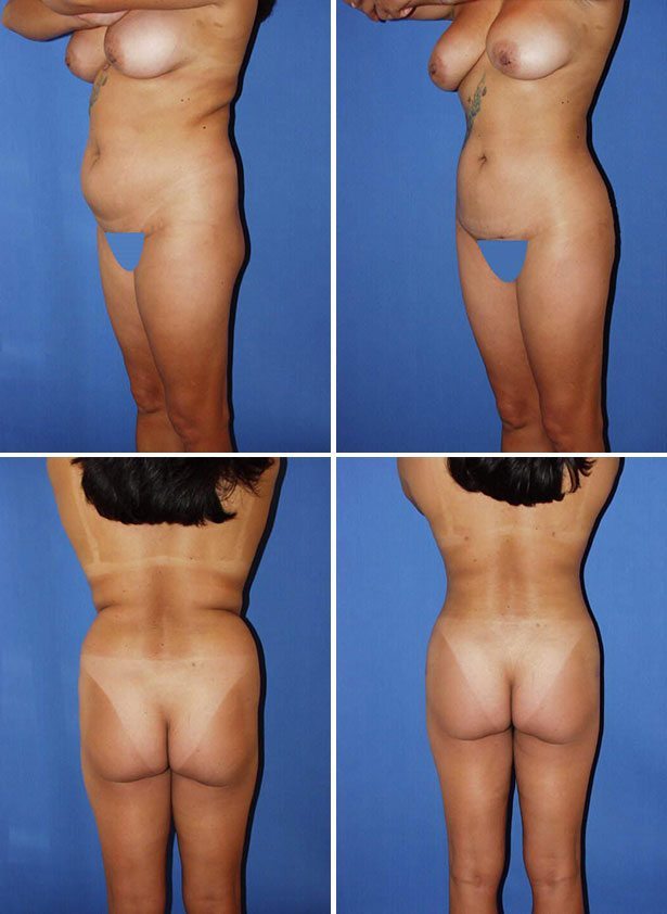 Before and After Image: Liposuction / Liposculpture Surgery - other