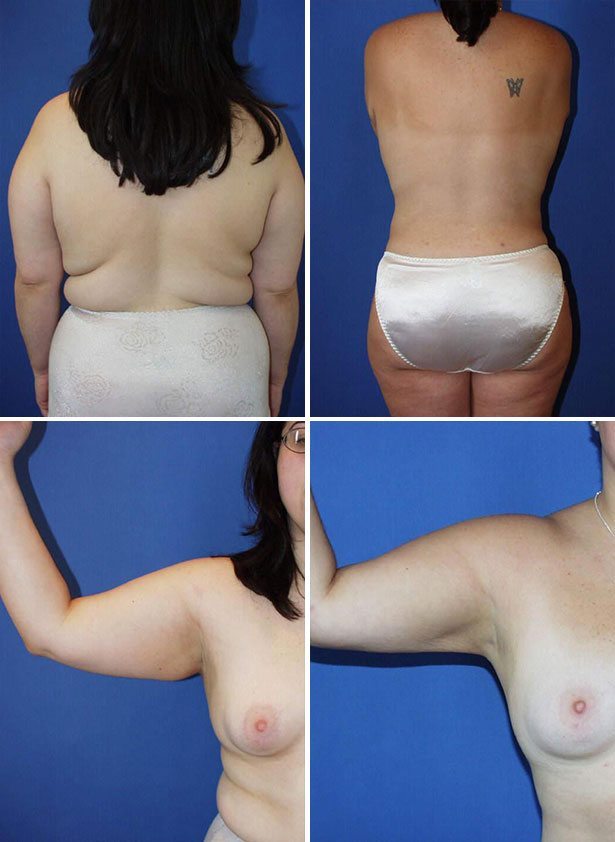 Before and After Image: Liposuction / Liposculpture Surgery - other