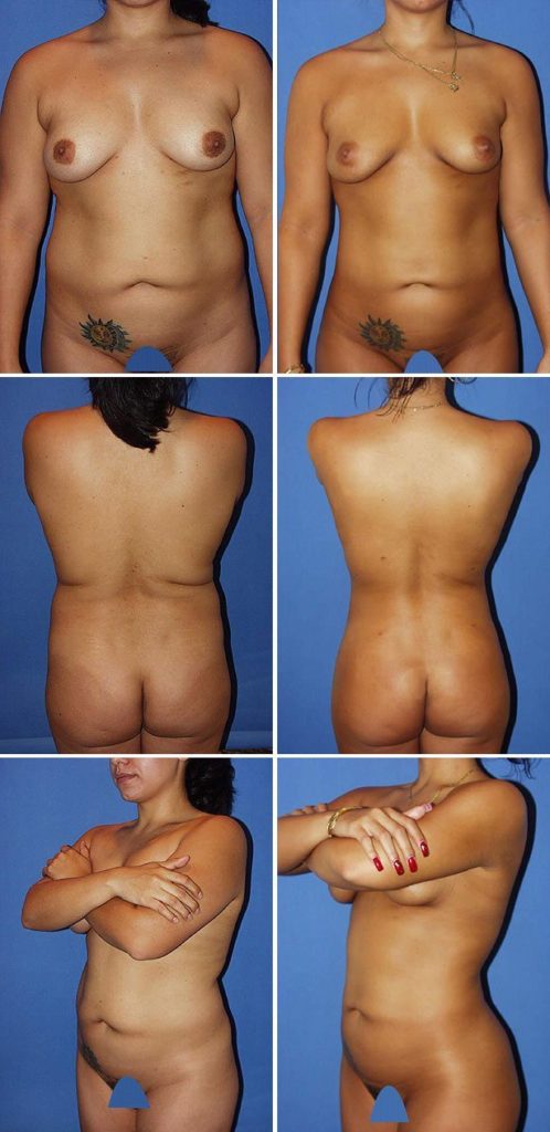Before and After Image: Liposuction / Liposculpture Surgery - other