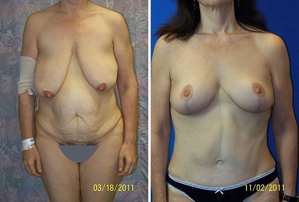 Before and After Image: Liposuction / Liposculpture Surgery - other