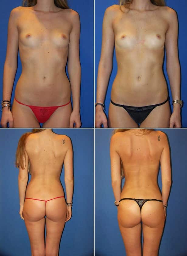 Before and After Image: Liposuction / Liposculpture Surgery - other
