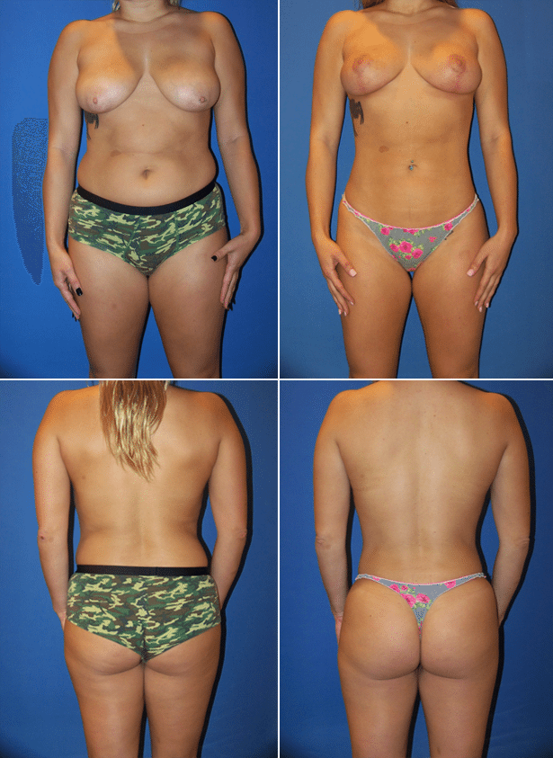 Before and After Image: Liposuction / Liposculpture Surgery - other
