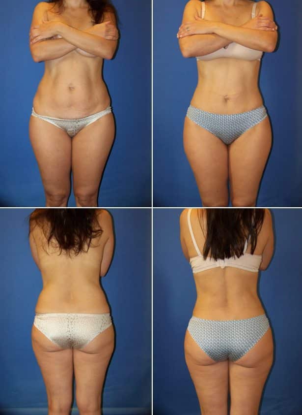 Before and After Image: Liposuction / Liposculpture Surgery - other