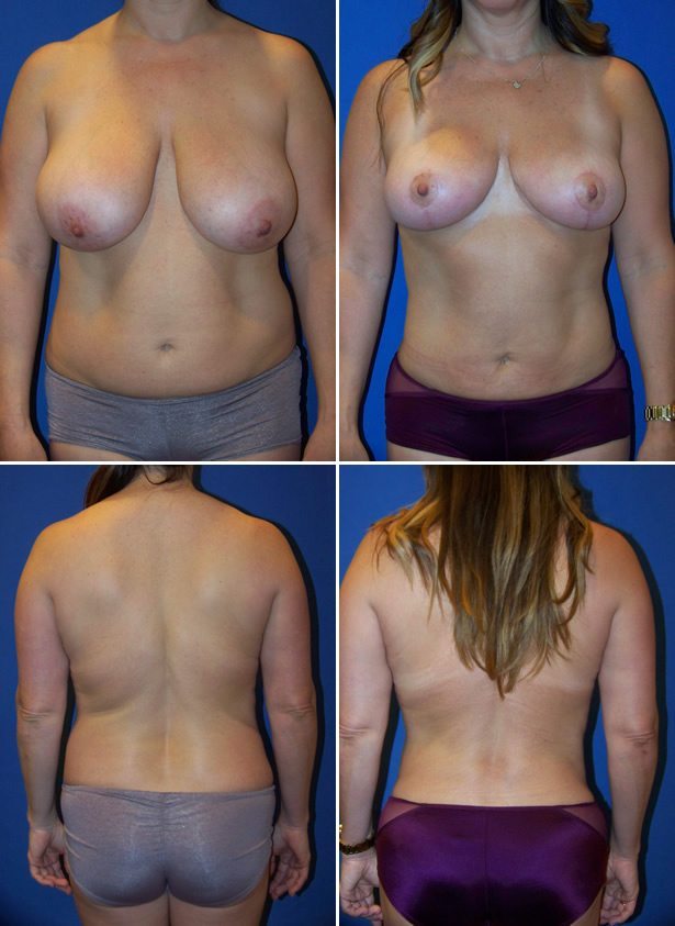 Before and After Image: Liposuction / Liposculpture Surgery - other