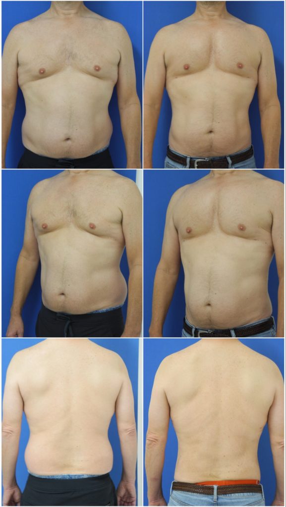 Before and After Image: Liposuction / Liposculpture Surgery - other