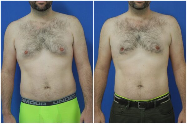 Before and After Image: Gynecomastia Correction - front