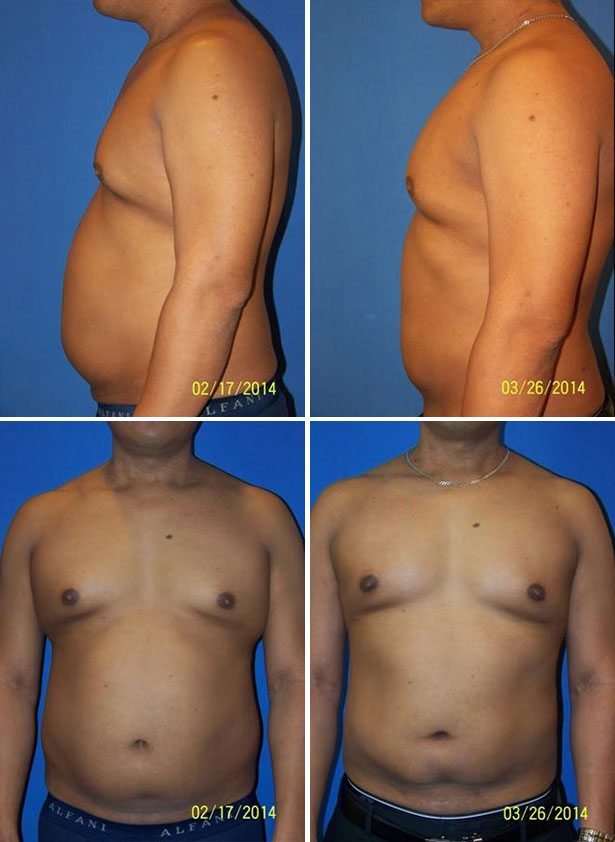 Before and After Image: Liposuction / Liposculpture Surgery - other