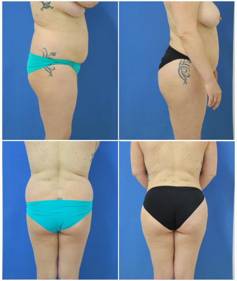 Before and After Image: Liposuction / Liposculpture Surgery - other