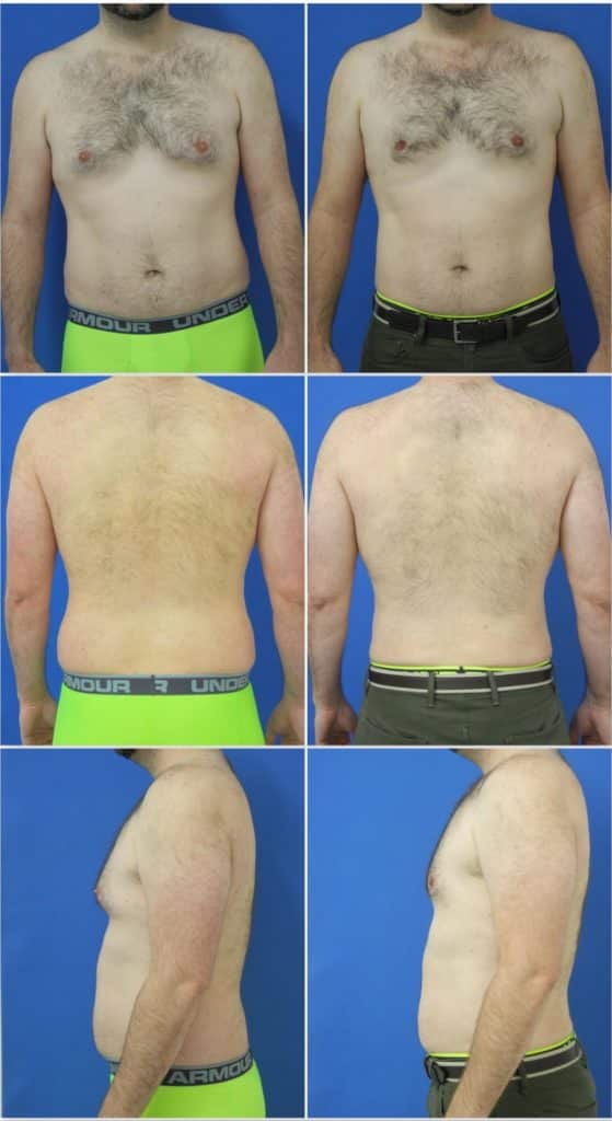 Before and After Image: Liposuction / Liposculpture Surgery - other