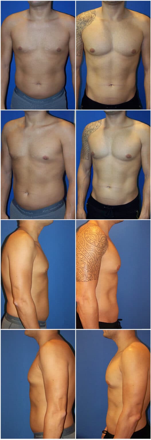 Before and After Image: Male Pec Implant - other
