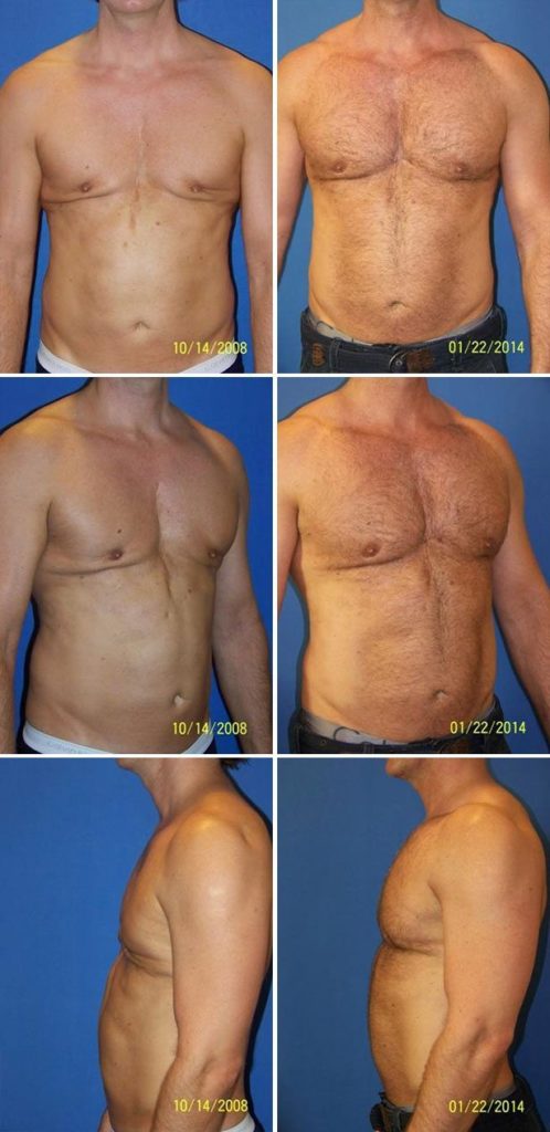 Before and After Image: Male Pec Implant - other