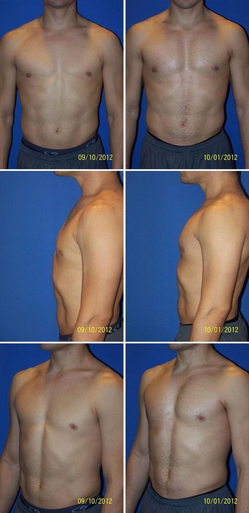 Before and After Image: Male Pectoral Implant - other
