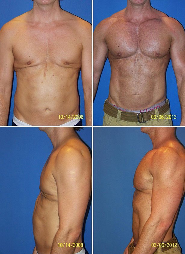 Before and After Image: Corrective Male Pectoral Implant - other
