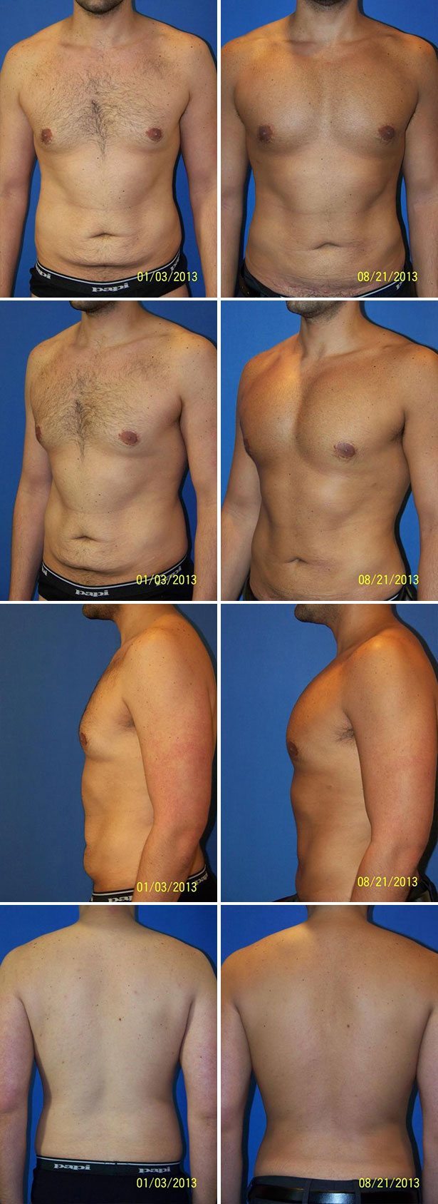 Before and After Image: Male Pectoral Implant - other